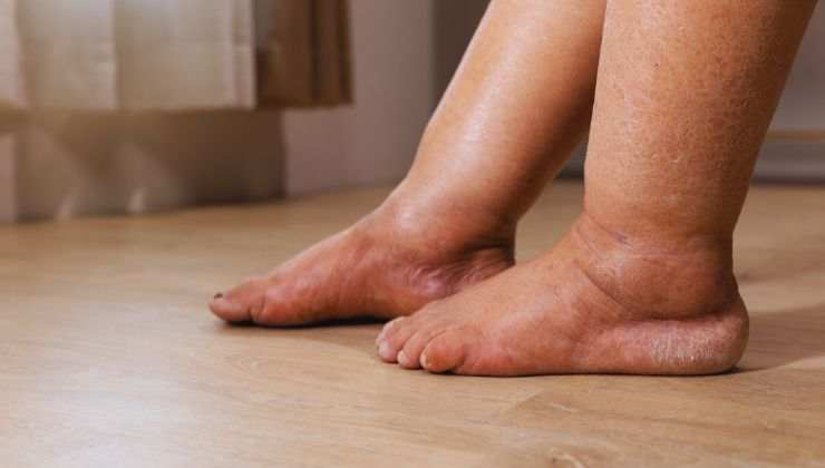 Edema a fosse per le gambe